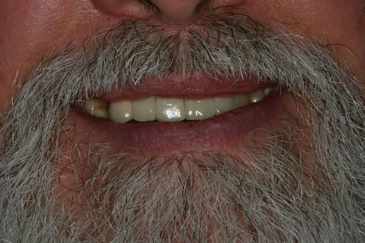 after picture of patient's smile after picture of patient's smile