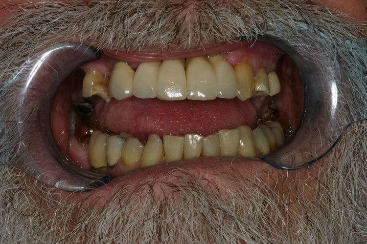 after picture of patient's smile after picture of patient's smile