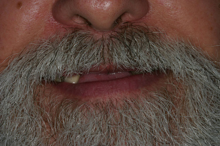 before picture of patient's smile before picture of patient's smile