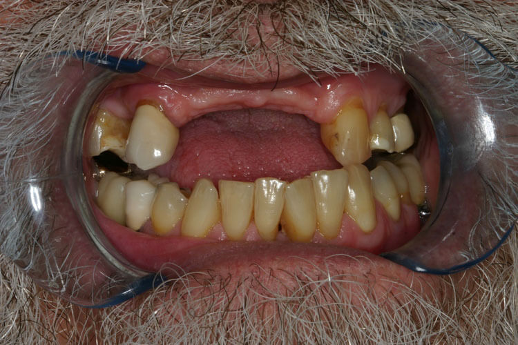 before picture of patient's smile before picture of patient's smile