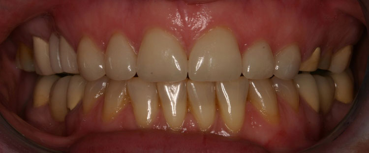 after picture of patient's smile after picture of patient's smile