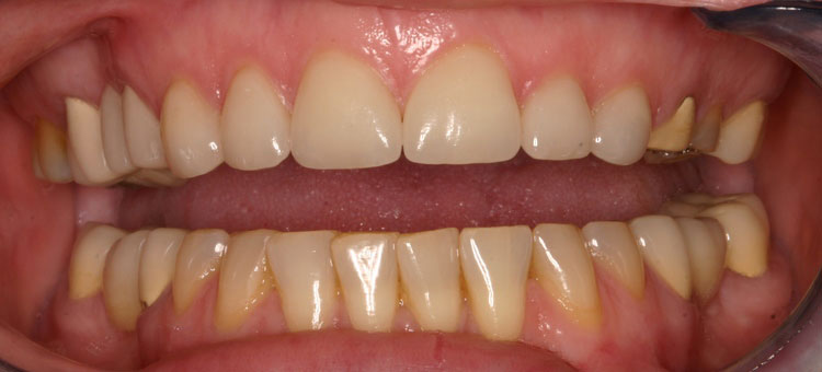 after picture of patient's smile after picture of patient's smile
