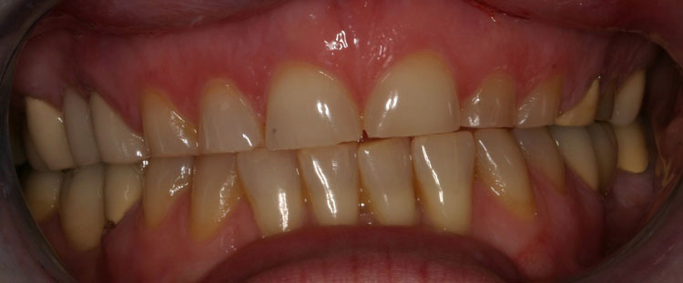 before picture of patient's smile before picture of patient's smile