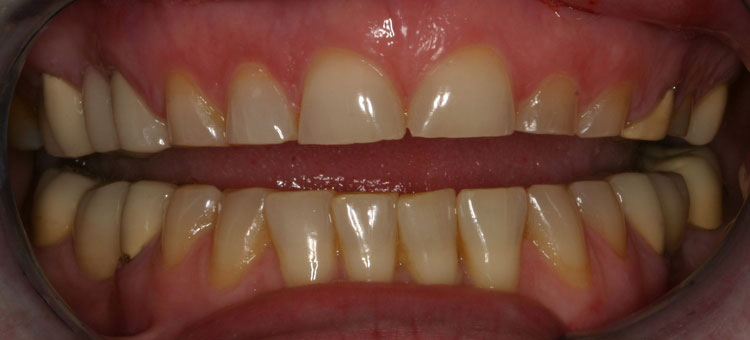before picture of patient's smile