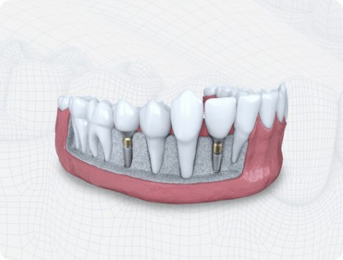 guided dental implants graphic