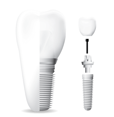 dental implant graphic