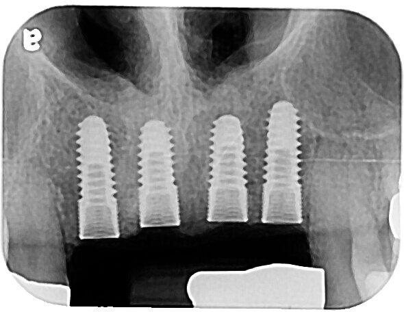 x-ray image of dental implants being placed