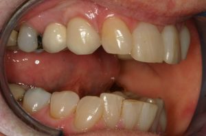 after picture of patient's smile