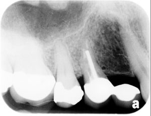 before picture of patient's tooth x-ray