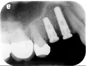 x-ray image of dental implants