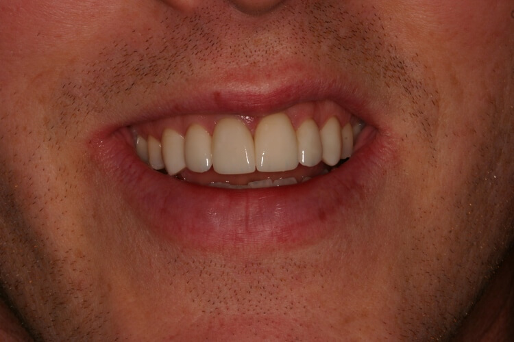 after picture of patient's smile after picture of patient's smile