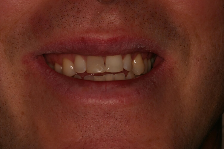 before picture of patient's smile before picture of patient's smile