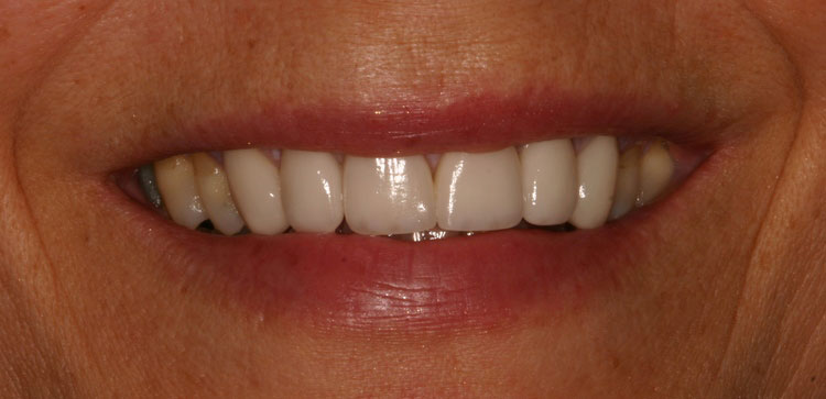 after picture of patient's smile