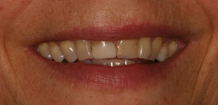 before picture of patient's smile