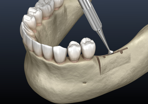 ridge augmentation