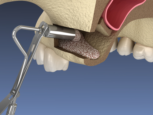 sinus lift