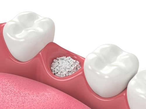 bone grafting