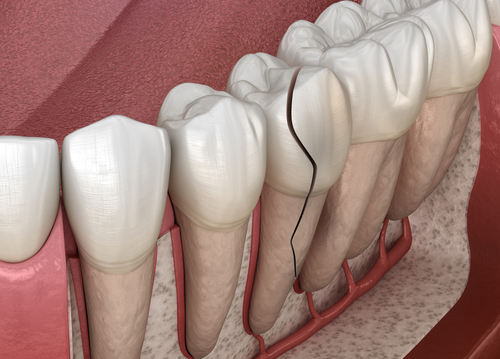 cracked tooth
