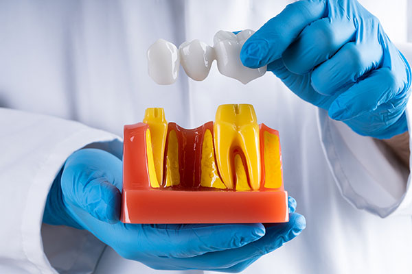 dental bridge figure