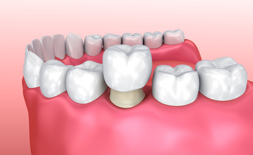 dental crown installation
