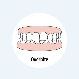 Overbite.,Dental,Problem